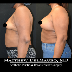 P78-Before-After-4-Months-–-Breast-Augmentation-Silicone6