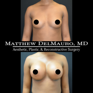 P83-Before-After-1-Months-Breast-Augmentation-Silicone2