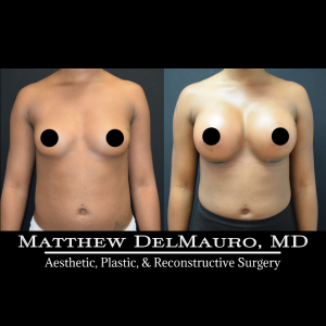P83-Before-After-1-Months-Breast-Augmentation-Silicone3