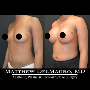 P83-Before-After-1-Months-Breast-Augmentation-Silicone5