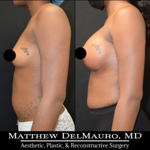 P83-Before-After-1-Months-Breast-Augmentation-Silicone6
