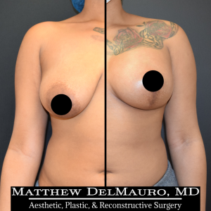 Before-After-1.25-Months-–-Breast-Lift-Inverted-T-with-Implants-Silicone1
