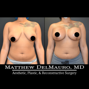Before-After-1.25-Months-–-Breast-Lift-Inverted-T-with-Implants-Silicone3