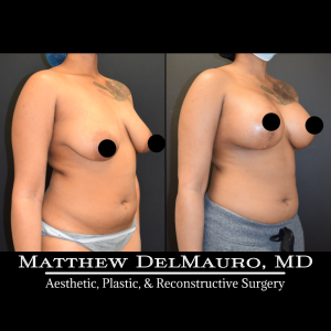Before-After-1.25-Months-–-Breast-Lift-Inverted-T-with-Implants-Silicone4