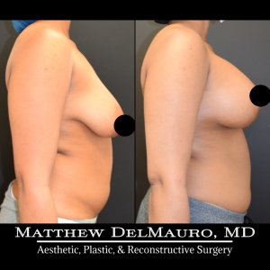 Before-After-1.25-Months-–-Breast-Lift-Inverted-T-with-Implants-Silicone5
