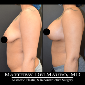 Before-After-1.25-Months-–-Breast-Lift-Inverted-T-with-Implants-Silicone6