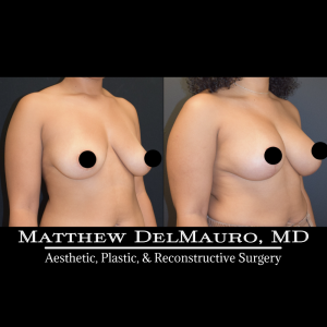 Before-After-11.5-Months-–-Breast-Lift-Vertical-with-Implants3