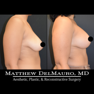 Before-After-11.5-Months-–-Breast-Lift-Vertical-with-Implants5