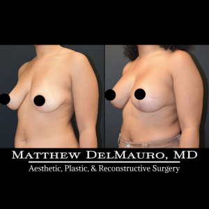 Before-After-11.5-Months-–-Breast-Lift-Vertical-with-Implants6