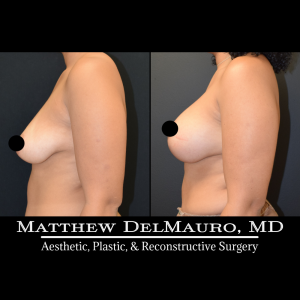 Before-After-11.5-Months-–-Breast-Lift-Vertical-with-Implants7