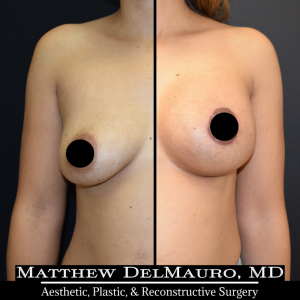 Before-After-3-Months-–-Breast-Lift-Circumareolar-with-Implants-Silicone1
