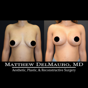 Before-After-3-Months-–-Breast-Lift-Circumareolar-with-Implants-Silicone2