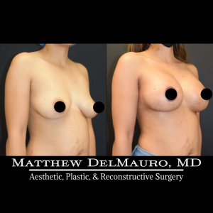Before-After-3-Months-–-Breast-Lift-Circumareolar-with-Implants-Silicone3