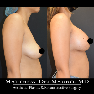 Before-After-3-Months-–-Breast-Lift-Circumareolar-with-Implants-Silicone4