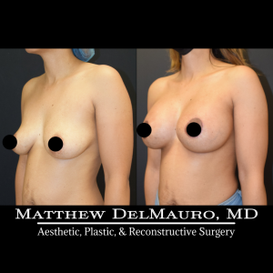 Before-After-3-Months-–-Breast-Lift-Circumareolar-with-Implants-Silicone5