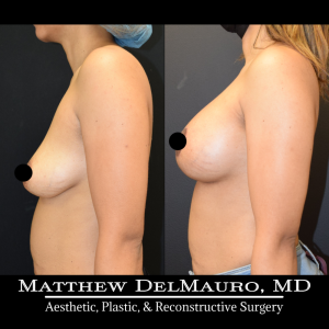 Before-After-3-Months-–-Breast-Lift-Circumareolar-with-Implants-Silicone6