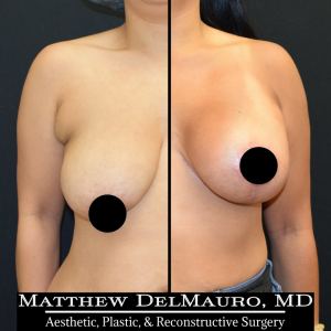 Before-After-3-Months-–-Breast-Lift-Inverted-T-with-Implants-Silicone1
