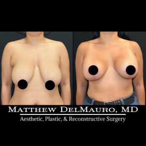 Before-After-3-Months-–-Breast-Lift-Inverted-T-with-Implants-Silicone2