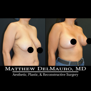 Before-After-3-Months-–-Breast-Lift-Inverted-T-with-Implants-Silicone3