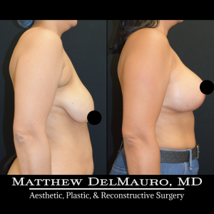 Before-After-3-Months-–-Breast-Lift-Inverted-T-with-Implants-Silicone4