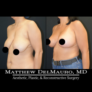 Before-After-3-Months-–-Breast-Lift-Inverted-T-with-Implants-Silicone5