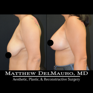 Before-After-3-Months-–-Breast-Lift-Inverted-T-with-Implants-Silicone6