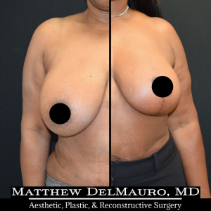 Before-After-3-Months-–-Breast-Lift-Reduction-Inverted-T-Superomedial1