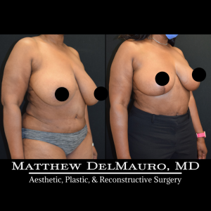 Before-After-3-Months-–-Breast-Lift-Reduction-Inverted-T-Superomedial2