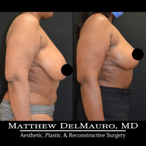 Before-After-3-Months-–-Breast-Lift-Reduction-Inverted-T-Superomedial3