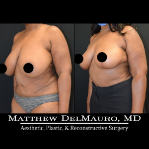 Before-After-3-Months-–-Breast-Lift-Reduction-Inverted-T-Superomedial4