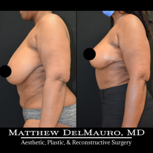 Before-After-3-Months-–-Breast-Lift-Reduction-Inverted-T-Superomedial5