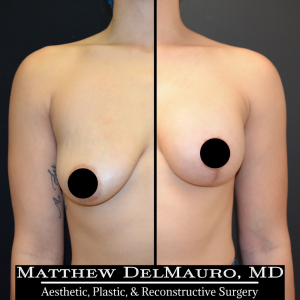 Before-After-3-Months-–-Breast-Lift-with-Implants1