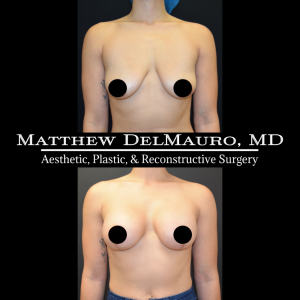 Before-After-3-Months-–-Breast-Lift-with-Implants2
