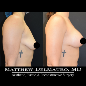 Before-After-3-Months-–-Breast-Lift-with-Implants3