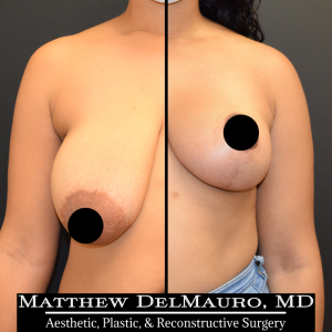 Before-After-3-Months-–-Breast-Lift1