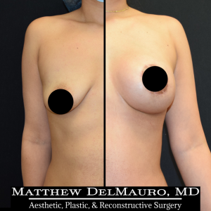 Before-After-3-Months-–-Lipoabdominoplasty-Breast-Lift-Circumareolar-with-Implants-Silicone1