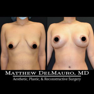 Before-After-3-Months-–-Lipoabdominoplasty-Breast-Lift-Circumareolar-with-Implants-Silicone2