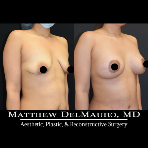 Before-After-3-Months-–-Lipoabdominoplasty-Breast-Lift-Circumareolar-with-Implants-Silicone3