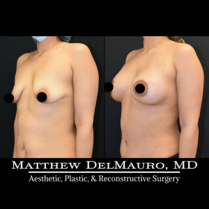 Before-After-3-Months-–-Lipoabdominoplasty-Breast-Lift-Circumareolar-with-Implants-Silicone4