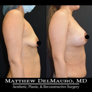 Before-After-3-Months-–-Lipoabdominoplasty-Breast-Lift-Circumareolar-with-Implants-Silicone5