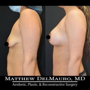Before-After-3-Months-–-Lipoabdominoplasty-Breast-Lift-Circumareolar-with-Implants-Silicone6