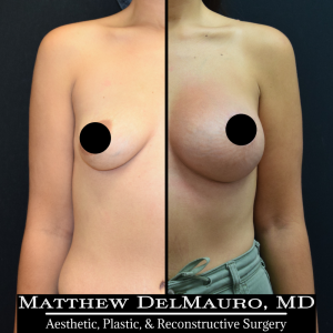 Before-After-3.5-Months-–-Breast-Lift-Circumareolar-with-Implants-Silicone1