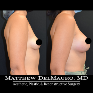 Before-After-3.5-Months-–-Breast-Lift-Circumareolar-with-Implants-Silicone3