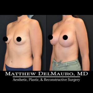 Before-After-3.5-Months-–-Breast-Lift-Circumareolar-with-Implants-Silicone4