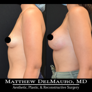 Before-After-3.5-Months-–-Breast-Lift-Circumareolar-with-Implants-Silicone5