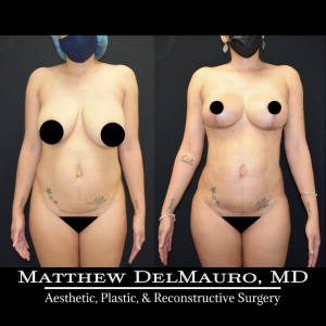 Before-After-3.5-Months-–-Breast-Lift-Liposuction-of-the-Abdomen-Flanks-Abdominal-Scar-Revision3