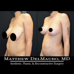 Before-After-3.5-Months-–-Breast-Lift-Liposuction-of-the-Abdomen-Flanks-Abdominal-Scar-Revision4