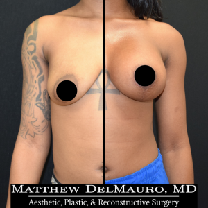 Before-After-3.5-Months-–-Breast-Lift-Vertical-with-Implants-Silicone1