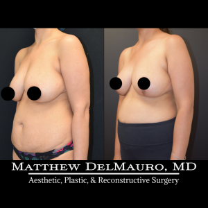 Before-After-4.5-Months-–-Breast-Lift-Inverted-T5