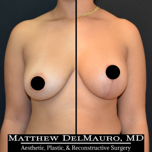 Before-After-5-Months-–-Breast-Lift-Vertical-with-Implants1
